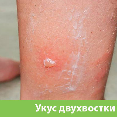 Укус двухвостки в Волжске