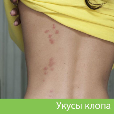 Профессиональное уничтожение клопов в Волжске